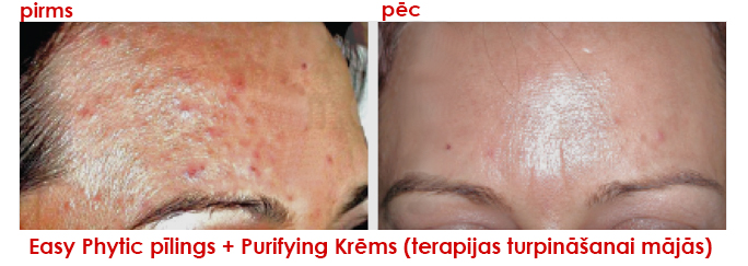 Easy Phytic pīlings + Purifying Krēms